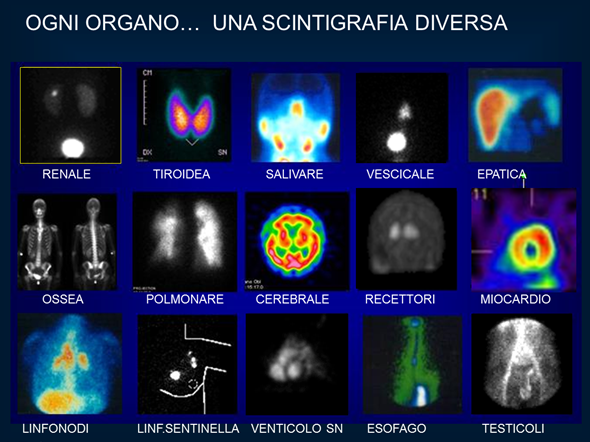 diagnostica mediconucleare tradizionale (scintigrafie)